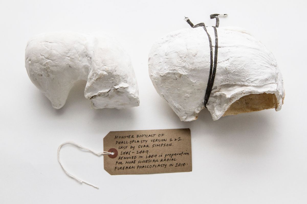 White plaster cast held together by tape.